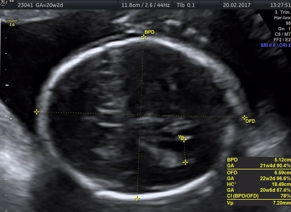 Kiedy wykonać badanie połówkowe? Kluczowe informacje dla przyszłych mam