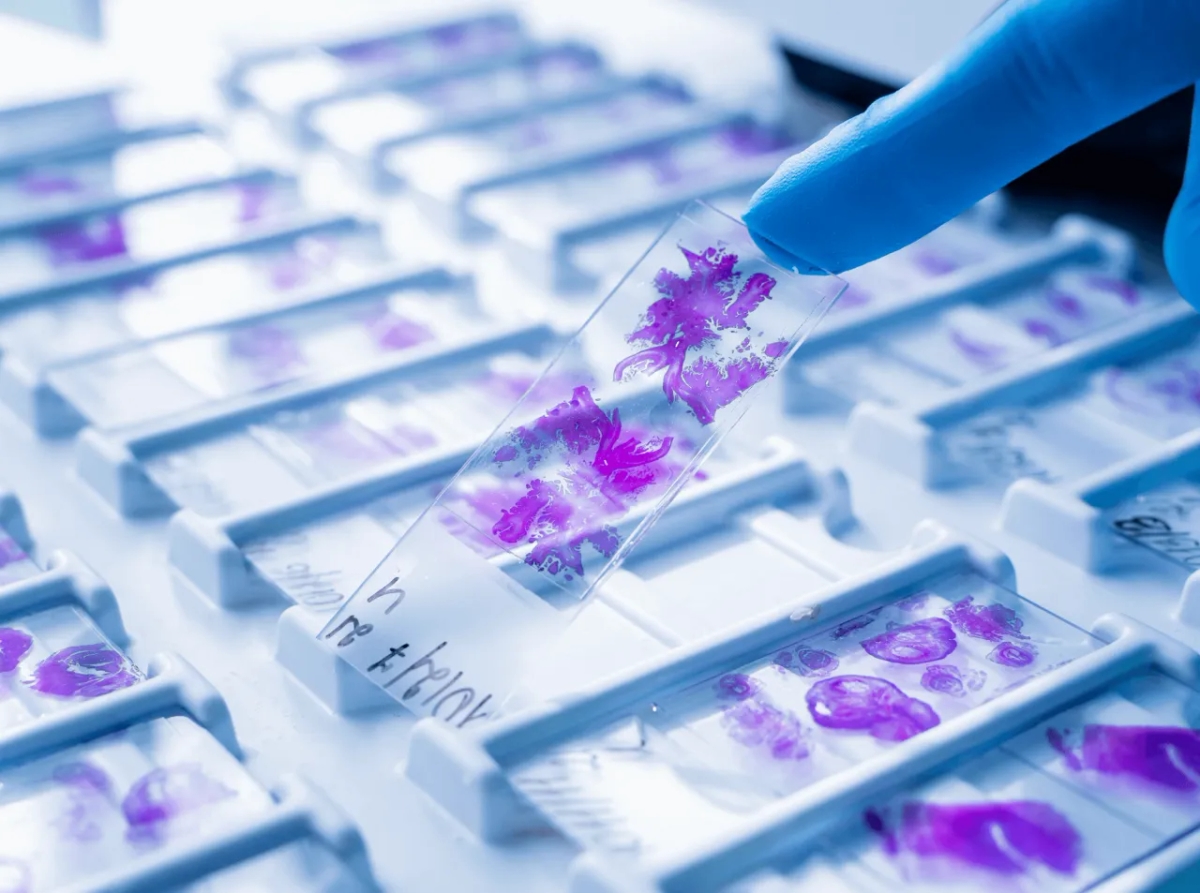 Czym jest badanie histopatologiczne? Klucz do diagnozy nowotworów